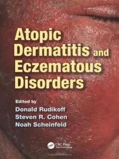 Atopic Dermatitis and Eczematous Disorders