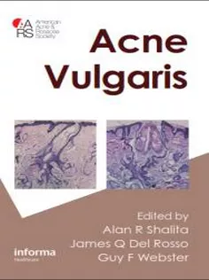 Acne Vulgaris