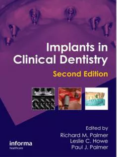 Implants in Clinical Dentistry