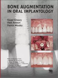 Bone Augmentation in Oral Implantology