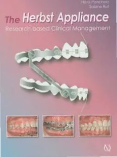 The Herbst Appliance: Research-based Clinical Management