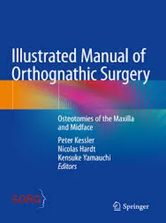 Illustrated Manual of Orthognathic Surgery Osteotomies of the Mandible