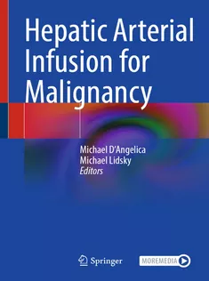Hepatic Arterial Infusion for Malignancy