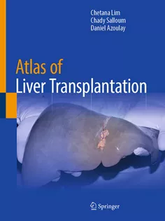 Atlas of Liver Transplantation