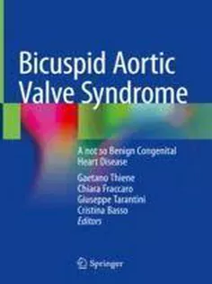 Bicuspid Aortic Valve Syndrome A Not So Benign Congenital Heart Disease