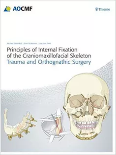 Principles of Internal Fixation of the Craniomaxillofacial Skeleton