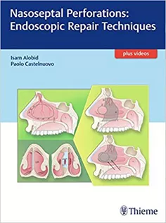 Nasoseptal Perforations: Endoscopic Repair Techniques