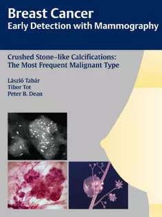 Breast Cancer-The Art and Science of Early Detection with Mammography