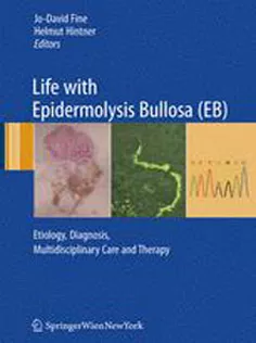 Life with Epidermolysis Bullosa(EB