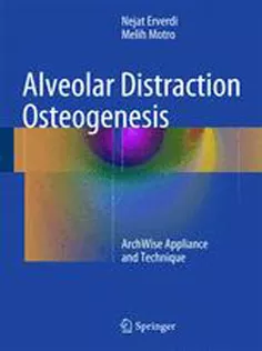 Alveolar Distraction Osteogenesis: ArchWise Appliance and Technique