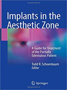 Implants in the Aesthetic Zone