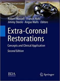 Extra-Coronal Restorations: Concepts and Clinical Application