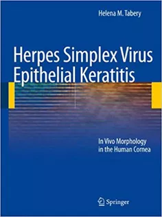 Herpes Simplex Virus Epithelial Keratitis