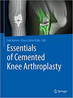Essentials of Cemented Knee Arthroplasty