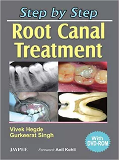 Step by Step Root Canal Treatment
