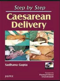 Step by Step Caesarean Delivery