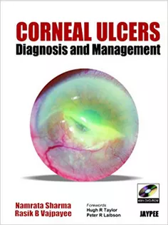 Corneal Ulcers Diagnosis and Management