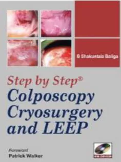 Step By Step Colposcopy Cryosur With Dv