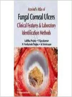 Aravind's Atlas of Fungal Corneal Ulcers