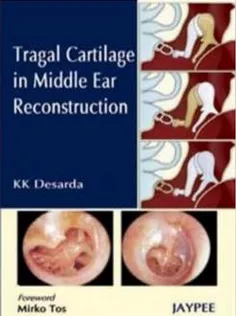 Tragal Cartilage in Middle Ear Reconstruction