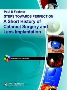 Steps Towards Perfection A Short History of Cataract Surgery & Lens Implantation