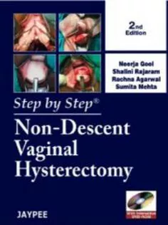 Step by Step Non-Descent Vaginal Hysterectomy