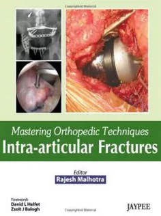 Mastering Orthopedic Techniques: Intra-Articular Fractures