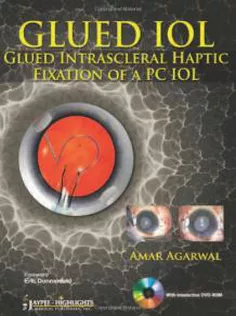 Glued IOL: Glued Intrascleral Haptic Fixation of A PC Iol
