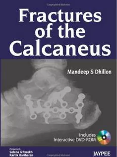 Fractures of the Calcaneus