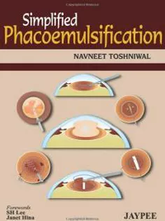 Simplified Phacoemulsification