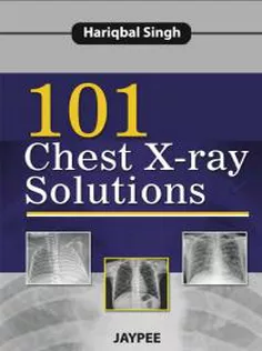 101Chest X-ray Solutions