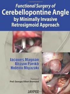 Functional Surgery of Cerebellopontine Angle by Minimally Invasive Retrosigmoid Approach