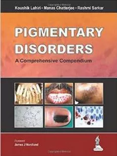 Pigmentary Disorders: A Comprehensive Compendium