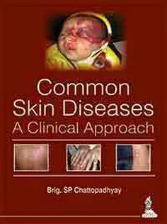 Common Skin Diseases-A Clinical Approach