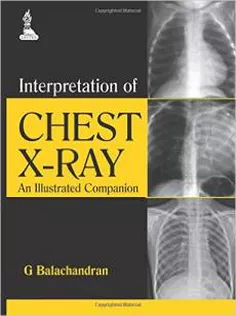 Interpretation of Chest X-Ray: An Illustrated Companion