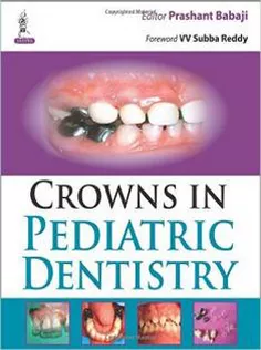 Crowns in Pediatric Dentistry