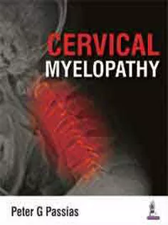 Cervical Myelopathy
