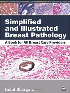 Simplified and Illustrated Breast Pathology