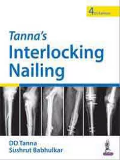 Tanna’s Interlocking Nailing