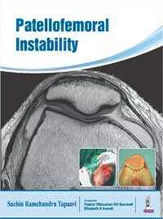 Patellofemoral Instability