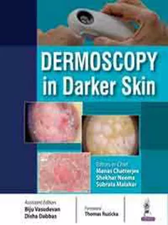 Dermoscopy in Darker Skin