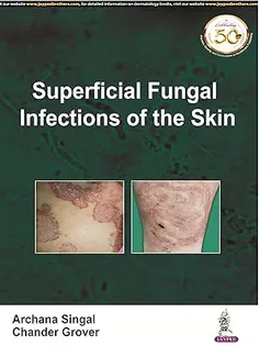 Superficial Fungal Infections of the Skin