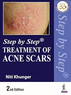 Step by Step Treatment of Acne Scars