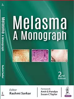 Melasma A Monograph