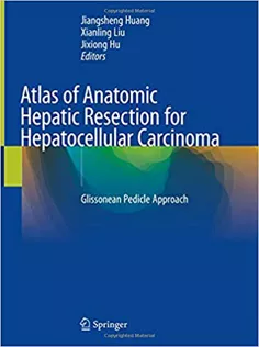 9789811306679 Atlas of Anatomic Hepatic Resection for Hepatocellular Carcinoma