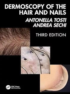 Dermoscopy of the Hair and Nails 3e