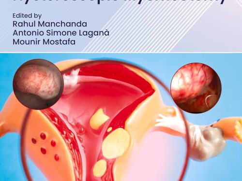9780443366703 A Complete Guide to Hysteroscopic Myomectomy