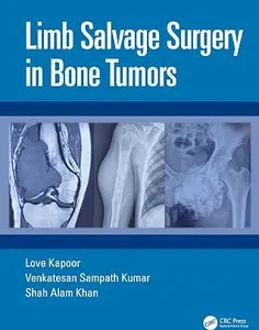 Limb Salvage Surgery in Bone Tumors