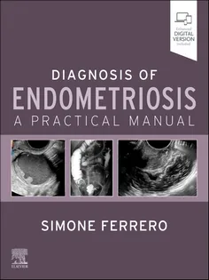 Diagnosis of Endometriosis